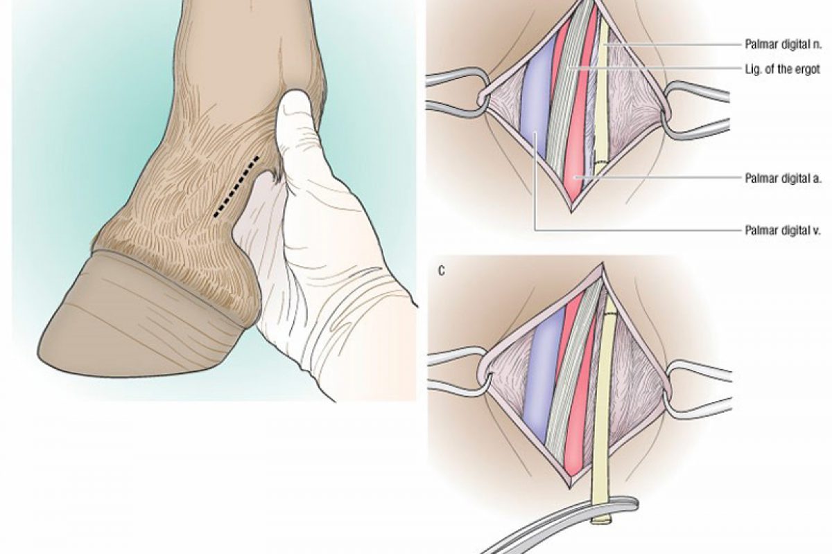 Neurectomy